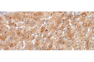 Immunohistochemistry of paraffin-embedded Human liver cancer tissue using GPC4 Polyclonal Antibody at dilution of 1:30(x200) (GPC4 抗体)