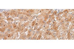 Immunohistochemistry of paraffin-embedded Human liver cancer tissue using GPC4 Polyclonal Antibody at dilution of 1:30(x200) (GPC4 抗体)