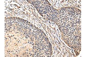 The image on the left is immunohistochemistry of paraffin-embedded Human esophagus cancer tissue using ABIN7128083(VIP Antibody) at dilution 1/20, on the right is treated with fusion protein. (Vip 抗体)