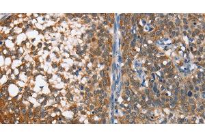 Immunohistochemistry of paraffin-embedded Human cervical cancer using MAD2L1BP Polyclonal Antibody at dilution of 1:65 (MAD2L1BP 抗体)