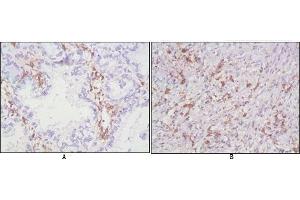 Immunohistochemical analysis of paraffin-embedded human lung cancer (A), lymphonodus tissue (B),showing cytomembrane localization using CD38 antibody with DAB staining. (CD38 抗体)