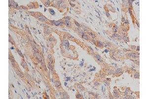 ABIN6267517 at 1/50 staining human lung cancer tissue sections by IHC-P. (MTOR 抗体  (pSer2448))
