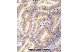 Formalin-fixed and paraffin-embedded human lung carcinoma tissue reacted with Autophagy G12L antibody (N-term) 1816a , which was peroxidase-conjugated to the secondary antibody, followed by DAB staining. (ATG12 抗体  (N-Term))