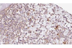 ABIN6273199 at 1/100 staining Human lymph cancer tissue by IHC-P. (BAMBI 抗体  (Internal Region))