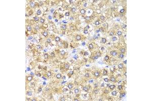 Immunohistochemistry of paraffin-embedded human liver cancer using SHMT2 antibody at dilution of 1:100 (400x lens). (SHMT2 抗体)
