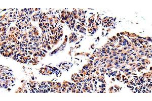 Immunohistochemistry of paraffin-embedded Human lung cancer using AKR1B1 Polyclonal Antibody at dilution of 1:40 (AKR1B1 抗体)