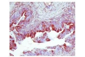 TIMP2 in human ovarian cancer was detected using HRP/AEC red color stain (TIMP2 抗体  (Middle Region))