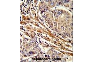Formalin-fixed and paraffin-embedded human hepatocarcinoma reacted with RT Antibody (C-term), which was peroxidase-conjugated to the secondary antibody, followed by DAB staining. (APRT 抗体  (C-Term))
