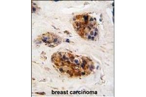 Formalin-fixed and paraffin-embedded human breast carcinoma tissue reacted with Vimentin antibody (Center), which was peroxidase-conjugated to the secondary antibody, followed by DAB staining.