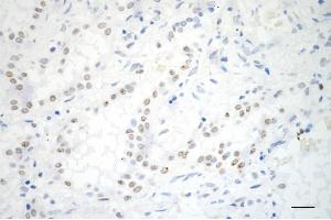 Immunohistochemistry was performed on paraffin-embedded human lung adenocarcinoma using ADAM17 antibody (ABIN7797502), 1:200). (Recombinant ADAM17 抗体)