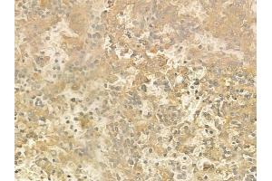 ABIN6260454 and ABIN6272856 at 1/100 staining human melanoma by IHC-P. (Caprin-1 抗体  (Internal Region))
