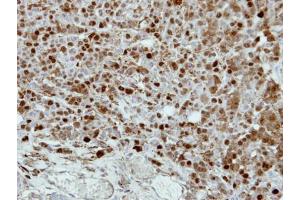 IHC-P Image Immunohistochemical analysis of paraffin-embedded MDAMB468 xenograft, using CRABP2, antibody at 1:500 dilution. (CRABP2 抗体)