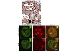 Formalin-fixed and paraffin-embedded human cancer tissue reacted with the primary antibody, which was peroxidase-conjugated to the secondary antibody, followed by DAB staining. (SETD2 抗体  (N-Term))