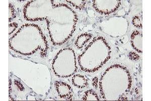 Immunohistochemical staining of paraffin-embedded Carcinoma of Human thyroid tissue using anti-GOLM1 mouse monoclonal antibody. (GOLM1 抗体)