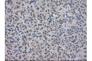 Immunohistochemical staining of paraffin-embedded Carcinoma of kidney tissue using anti-NAT8mouse monoclonal antibody. (NAT8 抗体)