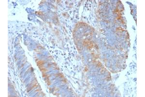 Formalin-fixed, paraffin-embedded human Colon Carcinoma stained with Calpain 1 Mouse Monoclonal Antibody (CAPN1/1530). (CAPNL1 抗体)