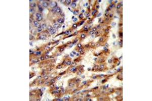 Formalin-fixed and paraffin-embedded human hepatocarcinoma reacted with ERGIC3 Antibody (N-term) followed which was peroxidase-conjugated to the secondary antibody, followed by DAB staining.