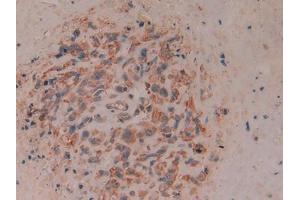 IHC-P analysis of Human Lung cancer Tissue, with DAB staining. (CD8B 抗体  (AA 22-170))