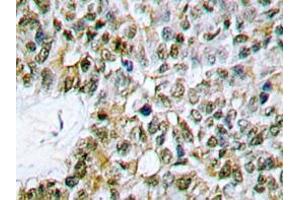 Immunohistochemistry analyzes of Caspase 9 antibody in paraffin-embedded human lung carcinoma tissue. (Caspase 9 抗体)