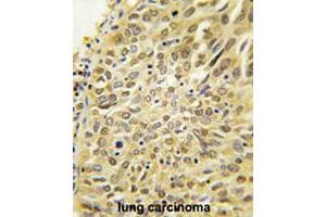Formalin-fixed and paraffin-embedded human lung carcinoma tissue reacted with UBQLN2 polyclonal antibody  , which was peroxidase-conjugated to the secondary antibody, followed by DAB staining. (Ubiquilin 2 抗体  (N-Term))