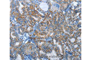Immunohistochemistry of Human thyroid cancer using AGL Polyclonal Antibody at dilution of 1:30 (AGL 抗体)