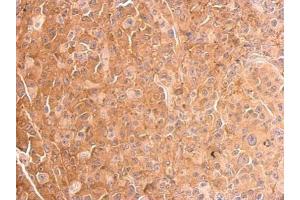 IHC-P Image Cofilin 1 antibody detects CFL1 protein at cytosol on HBL435 xenograft by immunohistochemical analysis. (Cofilin 抗体)