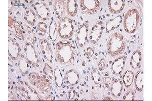 Immunohistochemical staining of paraffin-embedded Carcinoma of lung using anti-Stat4 (ABIN2452527) mouse monoclonal antibody. (STAT4 抗体  (AA 633-652))