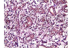 Formalin-fixed and paraffin embedded human breast carcinoma labeled with Anti-BRMS-1 Polyclonal Antibody, Unconjugated  at 1:200, followed by conjugation to the secondary antibody and DAB staining