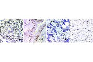 Staining of odontogenic tumors and odontogenic cyst: (1a) shows H and E stained SMA at x400, (1b) shows H and E stained OKC at x400, (1c) shows H and E stained AF at x400, (1d) shows H and E stained OM at x400.
