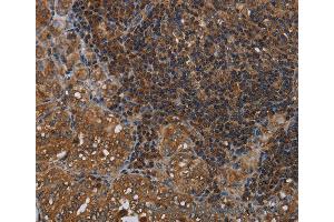 Immunohistochemistry of Human liver cancer using HOMER2 Polyclonal Antibody at dilution of 1:40