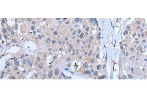 Immunohistochemistry of paraffin-embedded Human esophagus cancer tissue using YPEL5 Polyclonal Antibody at dilution of 1:60(x200) (YPEL5 抗体)