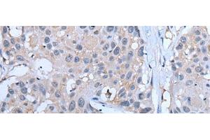 Immunohistochemistry of paraffin-embedded Human esophagus cancer tissue using YPEL5 Polyclonal Antibody at dilution of 1:60(x200) (YPEL5 抗体)