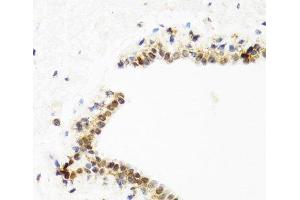 Immunohistochemistry of paraffin-embedded Human breast using TOP1 Polyclonal Antibody at dilution of 1:100 (40x lens). (Topoisomerase I 抗体)