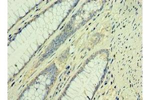 Immunohistochemistry of paraffin-embedded human colon cancer using ABIN7171560 at dilution of 1:100 (TAF1B 抗体  (AA 369-588))