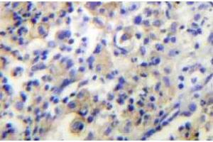 Immunohistochemistry (IHC) analyzes of TPH1 antibody in paraffin-embedded human lung carcinoma tissue. (Tryptophan Hydroxylase 1 抗体)