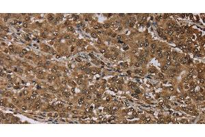 Immunohistochemistry of paraffin-embedded Human liver cancer tissue using MEIS1 Polyclonal Antibody at dilution 1:30 (MEIS1 抗体)