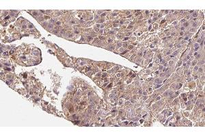 ABIN6279838 at 1/100 staining Human liver cancer tissue by IHC-P. (SLC4A7 抗体  (Internal Region))