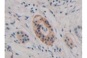 Detection of H2AFY in Human Pancreatic cancer Tissue using Polyclonal Antibody to H2A Histone Family, Member Y (H2AFY) (H2AFY 抗体  (AA 109-369))