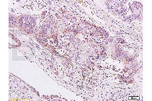 Formalin-fixed and paraffin embedded human gastric carcinoma labeled Anti-B7H4 Polyclonal Antibody, Unconjugated (ABIN671736) at 1:200, followed by conjugation to the secondary antibody and DAB staining (VTCN1 抗体  (AA 50-100))