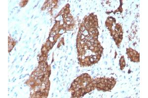 Formalin-fixed, paraffin-embedded human Breast Carcinoma stained with PDZ and LIM Domain 1 Mouse Monoclonal Antibody (PDLIM-1). (PDLIM1 抗体)