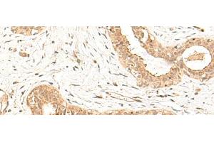 Immunohistochemistry of paraffin-embedded Human breast cancer tissue using FBXL4 Polyclonal Antibody at dilution of 1:25(x200) (FBXL4 抗体)