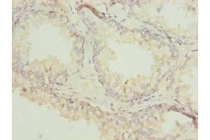 Immunohistochemistry of paraffin-embedded human prostate cancer using ABIN7143059 at dilution of 1:100 (Actl7b 抗体  (AA 1-415))