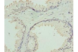 Immunohistochemistry of paraffin-embedded human prostate cancer using ABIN7154735 at dilution of 1:100 (GNa14 抗体  (AA 8-303))