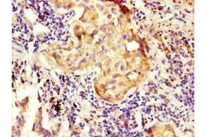 Immunohistochemistry of paraffin-embedded human lung cancer using ABIN7161015 at dilution of 1:100 (NOXA1 抗体  (AA 150-313))