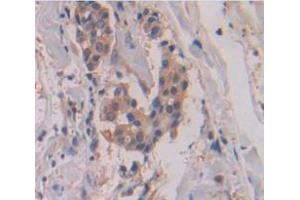 IHC-P analysis of Human Tissue, with DAB staining. (MMP13 抗体  (AA 290-468))