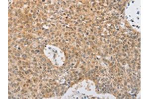 The image on the left is immunohistochemistry of paraffin-embedded Human lung cancer tissue using ABIN7131039(SERPINE2 Antibody) at dilution 1/20, on the right is treated with fusion protein. (SERPINE2 抗体)