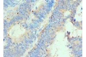 Immunohistochemistry of paraffin-embedded human colon cancer using ABIN7155937 at dilution of 1:100 (HIP1 抗体  (AA 410-690))
