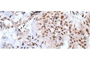 Immunohistochemistry of paraffin-embedded Human liver cancer tissue using XAB2 Polyclonal Antibody at dilution of 1:25(x200) (XAB2 抗体)