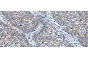 Immunohistochemistry of paraffin-embedded Human liver cancer tissue using BICD2 Polyclonal Antibody at dilution of 1:70(x200) (BICD2 抗体)
