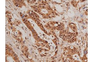 ABIN6267627 at 1/50 staining human colon cancer tissue sections by IHC-P.